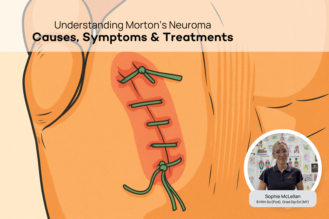 What is Morton's Neuroma? A Podiatrist Explains the Causes and Treatment