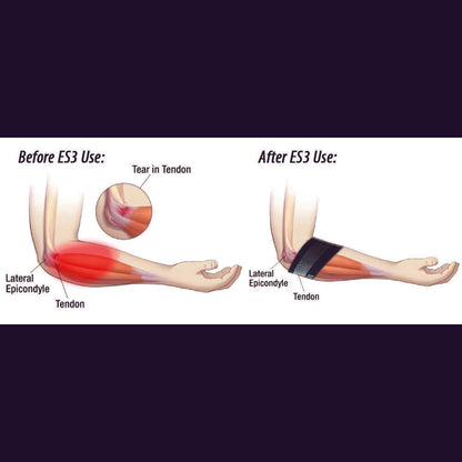 Elbow Compression Sleeve For Bursitis (ES3) - Black